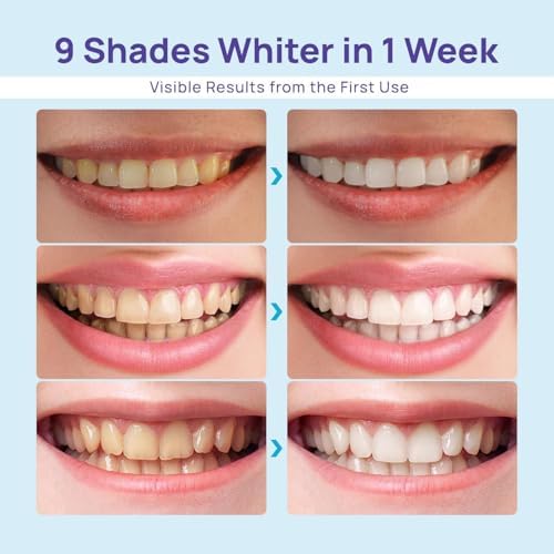 Whitebite Pro Teeth Whitening Kit for Sensitive Teeth – 32X LED Light + 35% Carbamide Peroxide Gel + Remineralizing Gel | Dental-Grade Whitening at Home